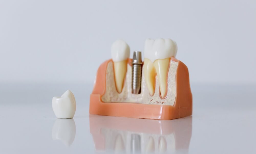 Dental Implants in Kennett, MO